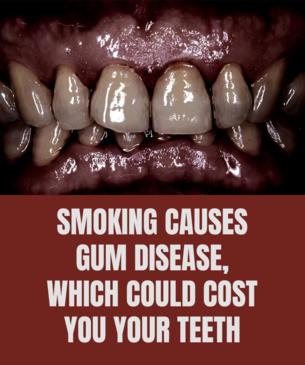 Smoking causes gum disease, which could cost you your teeth
